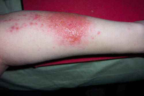 Urushiol-induced contact dermatitis 7 days after contact